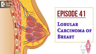 Lobular Carcinoma Of Breast  Milk producing gland CancerDrSandeep NayakSamrohanaDoctors Circle [upl. by Lodge]