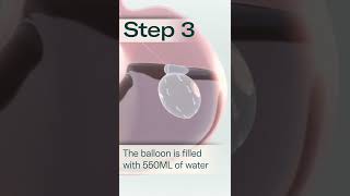 Allurion Gastric Balloon  A Simple Solution to Lasting Weight Loss [upl. by Ozan]