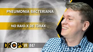 APRENDA COMO IDENTIFICAR A PNEUMONIA BACTERIANA NO RAIO X DE TÓRAX I VOCÊ RADIOLOGISTA [upl. by Oconnor]