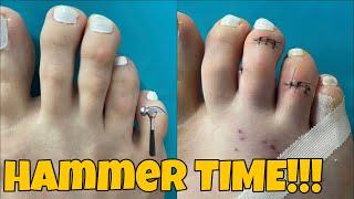 MINIMALLY INVASIVE HAMMERTOE SURGERY [upl. by Rollin]