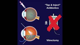 EVS  Endophthalmitis Vitrectomy Study [upl. by Morrison]