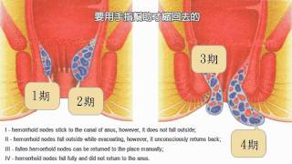 痔瘡甚麼情況下需要做手術 香港痔瘡中心 查詢31163836 [upl. by Ide294]