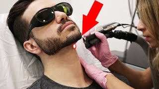 LASER HAIR REMOVAL FOR MEN  DOES IT HURT ALEX COSTA [upl. by Goldia]