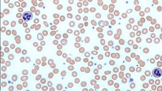 Diagnosis of Anaemia खून की कमी Peripheral Blood Smear [upl. by Silirama894]