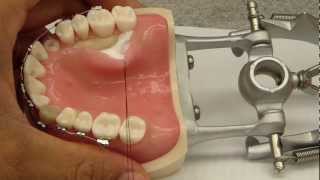 Palatal Flap Elevation Assistance  Connective tissue graftCrown Lengthening [upl. by Sissie]