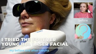 I TRIED THE FOREVER YOUNG BBL LASER FACIAL  HERE ARE MY RESULTS [upl. by Sagerman]