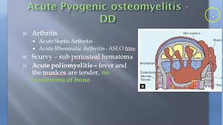 Orthopedics Pyogenic OsteoMyelitis DD Differential Diagnosis Acute Chronic [upl. by Algy]