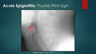 Acute Epiglottitis Thumb Sign [upl. by Assirralc]