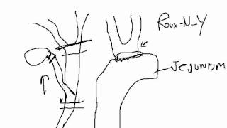 Common bile duct exploration Never laparoscopically [upl. by Acemat]