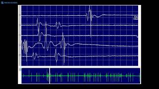 Kimura amp Kohara F32 Typical fasciculation potentials [upl. by Temirf206]