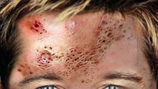 Blackhead Kings Biggest Pimple Popping Compilation 2022 [upl. by Jeremias]