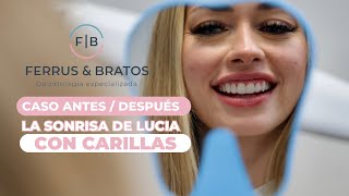 💋 CARILLAS DENTALES de PORCELANA ✨ Sonrisa perfecta [upl. by Repooc]