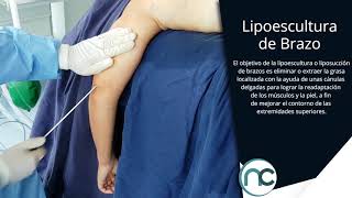 Dr Nelson Chaves  Lipoescultura de Brazo [upl. by Giacomo]