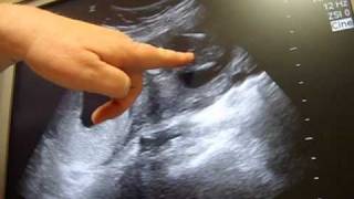 16 weeks gender ultrasound  Its a [upl. by Alsworth301]