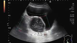 Ultrasound Video showing an ovarian cyst with multiple seedling fibroids [upl. by Mackie19]