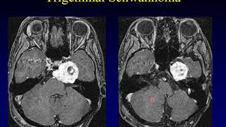 Temporal Bone Pathology 2 Cerebellopontine Angle [upl. by Assetal268]