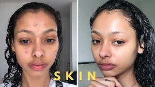 How my forehead acne cleared up [upl. by Eidda825]