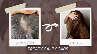 HOW TO TREAT SCALP SCABS [upl. by Janot]