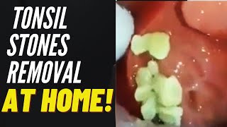 Salamat Dok Information about tonsil stones [upl. by Tserof]