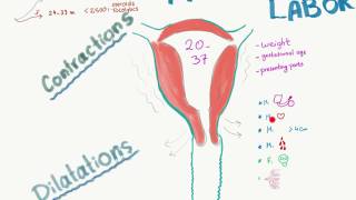 Preterm Labor visual summary [upl. by Atwater417]