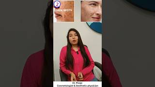 Chemical Peels for face in indore Laser treatment face in indore  Face Hyperpigmentation [upl. by Kee]