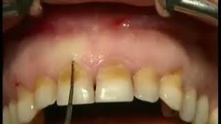 DİŞ ETİ İLTİHABI AMELİYATI Gingival surgery operation external belev diş eti iltihabı tedavisi [upl. by Allerym]