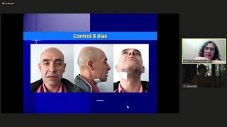 Periodontitis Apical AgudaAbsceso Fenix PART 3 [upl. by Sixel633]