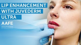 Adding More Lip Volume with Juvederm Ultra  AAFE [upl. by Cida]