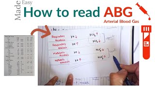 How to check ABG or arterial blood gas  ABG Interpretation [upl. by Eelatan]