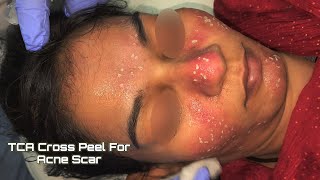 TCA CROSS FOR ACNE SCARS DETAILED VIDEO DrArifMDDermatologist acnescartreatment acnescars acne [upl. by Ennovaj]