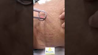 Laser Stretch Marks Removal Treatment In Hyderabad  Best Treatment For Stretch Marks  Hyderabad [upl. by Otecina765]