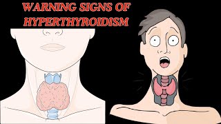 Warning Signs of Hyperthyroidism  Hyperthyroidism Symptoms [upl. by Lemire]