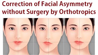 Correction of Facial Asymmetry Without Oral Surgery Using Orthotropics Method By Dr Mike Mew [upl. by Ley]