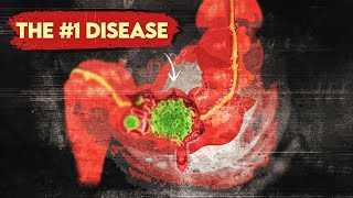 The 1 Disease More Common than Heart Disease and Cancer [upl. by Amesari]