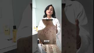 Quick Tips to Get Rid of Back Acne Fast acne acneexpert acnetreatment bodyacne skincare [upl. by Macri]