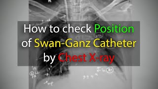 Pulmonary Artery SwanGanz Catheter position check in Chest X ray [upl. by Nivonod]