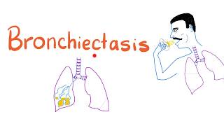 Bronchiectasis [upl. by Ayardna]