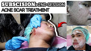 SECOND SESSION SUBCISION FOR ACNE SCARS  5 IN 1 SYNERGISTIC ACNE SCAR TREATMENT [upl. by Sirois]