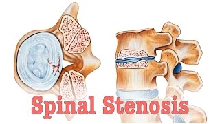 Spinal Stenosis  Surgery vs Chiropractic Care [upl. by Assetniuq]