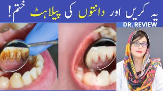 The 1 Top Remedy for Dental Plaque TARTAR [upl. by Anaigroeg285]