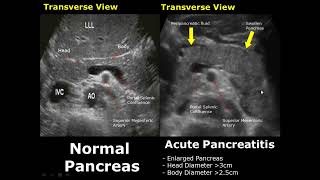 Pancreas Ultrasound Normal Vs Abnormal Image Appearances Comparison  Pancreatic Pathologies USG [upl. by Danzig172]