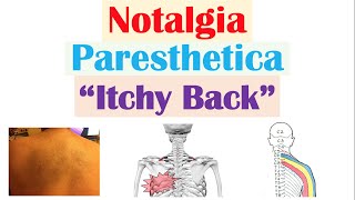 Notalgia Paresthetica “Itchy Back”  Causes Risk Factors Symptoms Diagnosis Treatment [upl. by Black]