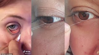 Super Satisfying EyE String And Eye Booger Removal  TiKTok Compilation [upl. by Shanie802]