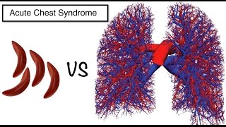 acute chest syndrome in sickle cell patients [upl. by Giltzow]