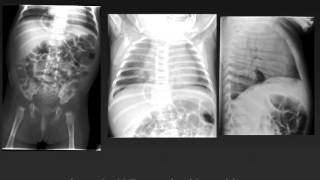 Approach to neonatal abdominal radiographs [upl. by Huey]