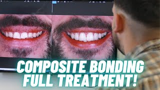 Worn teeth restored with composite bonding  FULL cosmetic treatment [upl. by Noguchi]