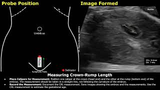 Step By Step Guide On 7 Week Pregnancy Transabdominal Ultrasound Scan  Full Protocol With Reporting [upl. by Becker]