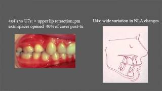 Treatment and stability of Class II Division 2 malocclusion in children and adolescents [upl. by Lessur135]