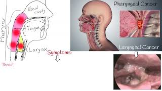 Throat cancer  Symptoms causes and Treatment Laryngeal Cancer and Pharyngeal Cancer [upl. by Earahs]