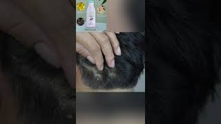 Wash dandruff to recover confidence dandruff dandrufftreatment [upl. by Erda662]